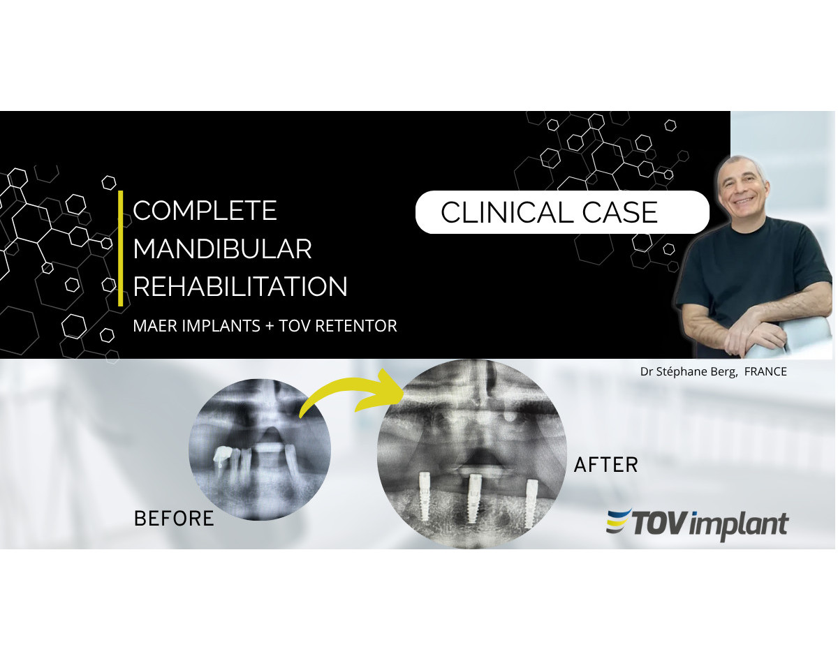 Réhabilitation mandibulaire complète par implants MAER et système Retentor TOV Implant